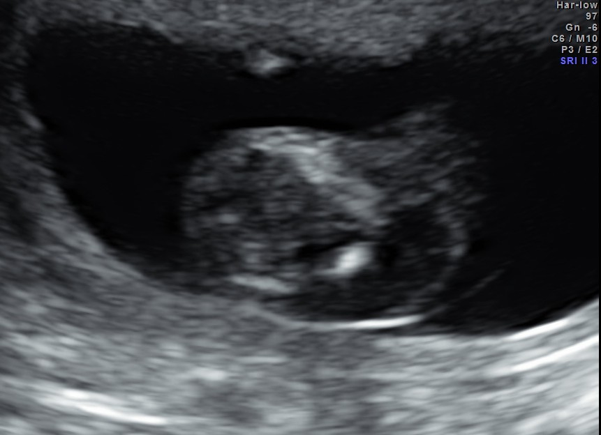 cystic swelling in the posterior aspect of the neck