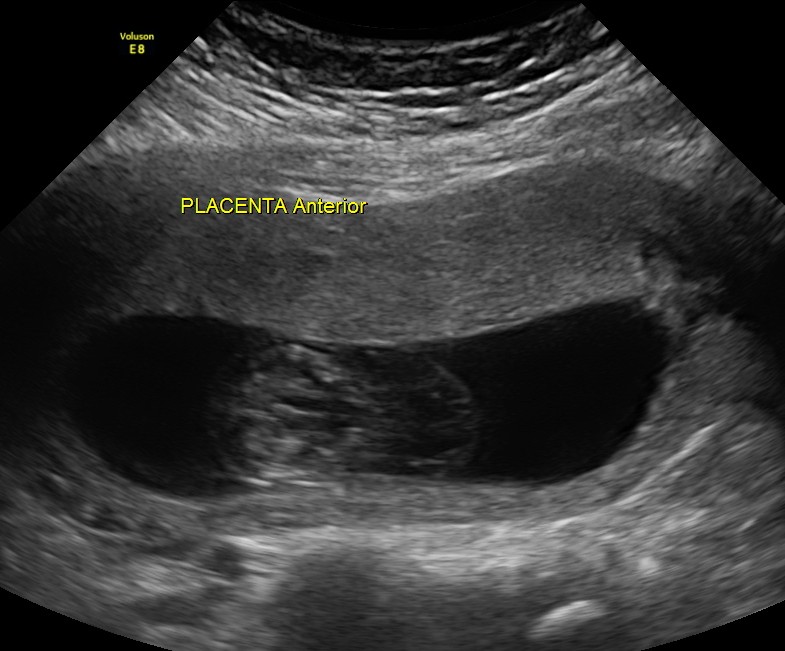 thin septations seen in the cystic swelling