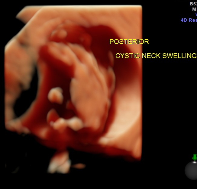 CYSTIC HYGROMA 3 D_12