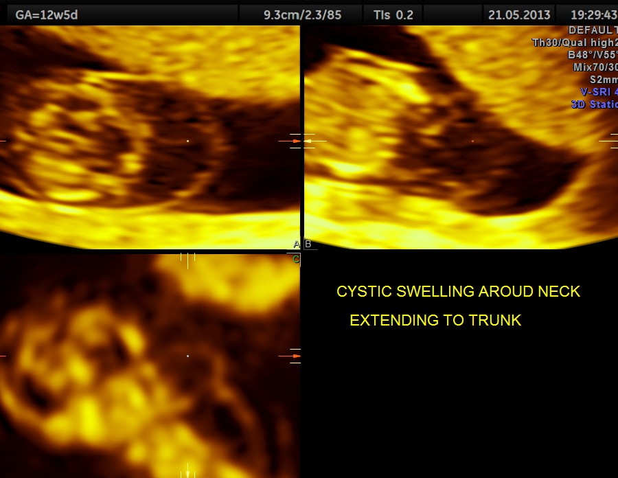 cystic swelling in the posterior aspect of the neck