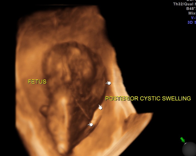 CYSTIC HYGROMA 3 D_5