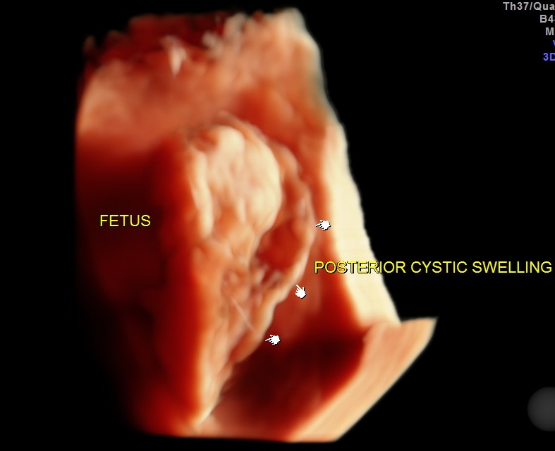 CYSTIC HYGROMA 3 D_6