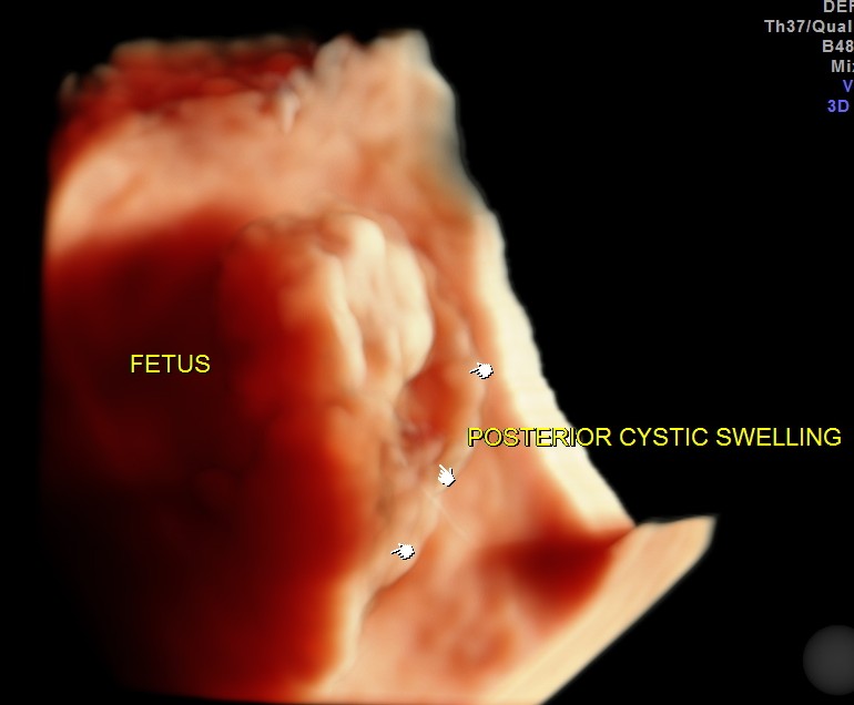 CYSTIC HYGROMA 3 D_7