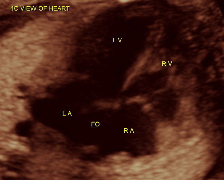 normal 4 chamber view