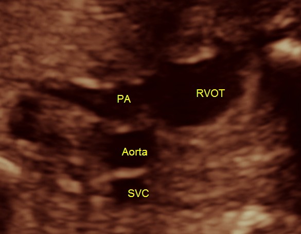 normal 3 vessel view