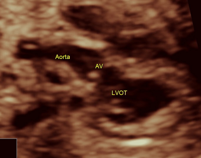 normal lvot giving rise to the aorta