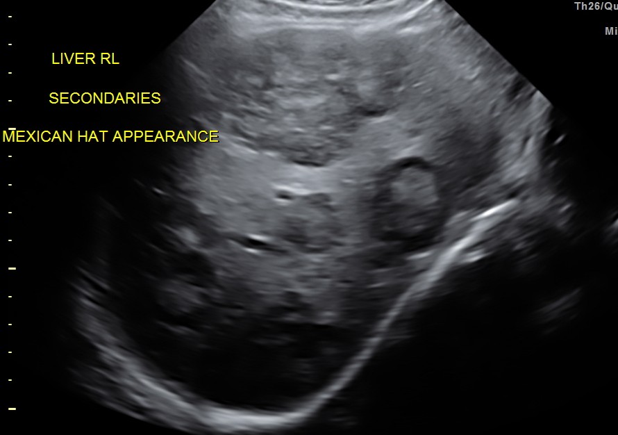secondaries show target appearance or bird's eye view of mexican hat appearance