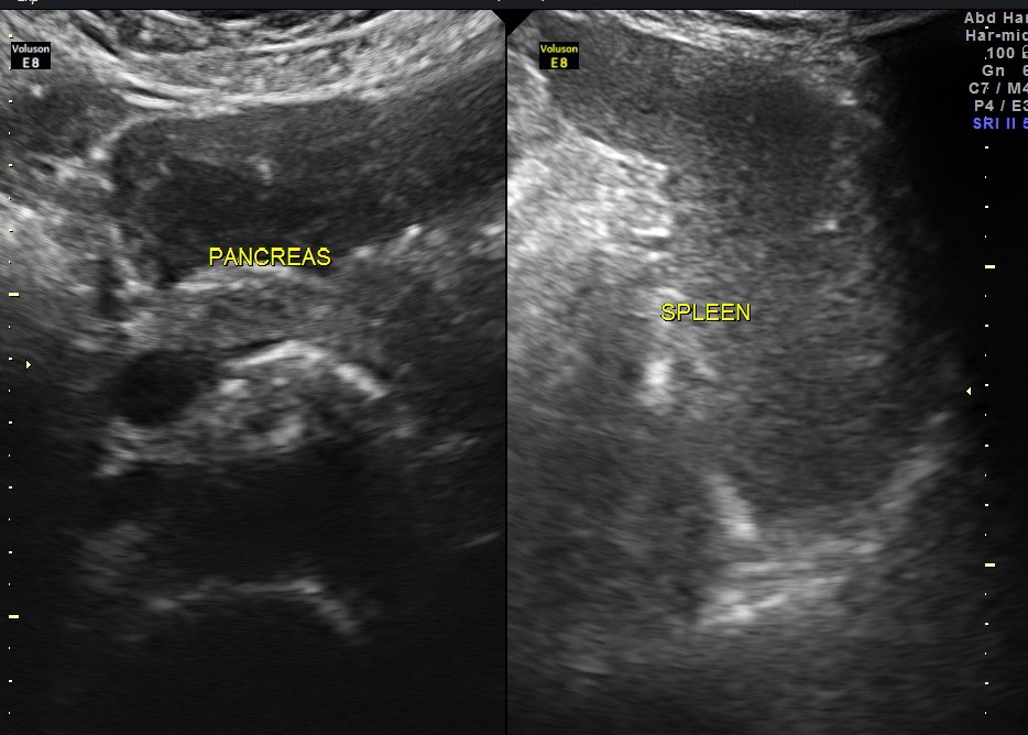 pancreas and spleen appeared to be normal