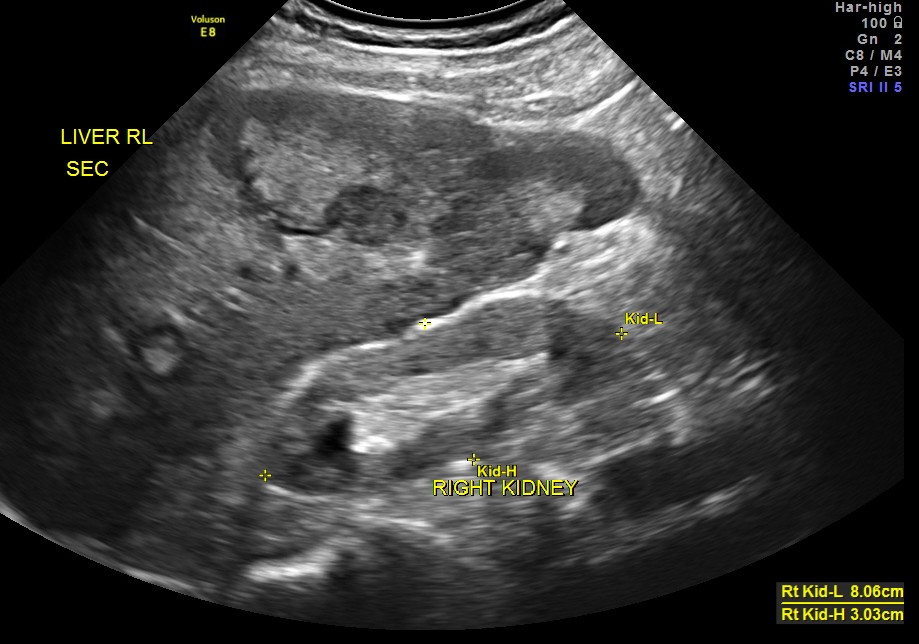 his right kidney appeared to be shrunk