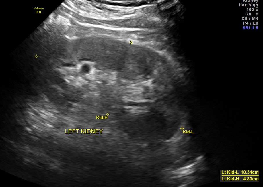 his left kidney appeared to be normal