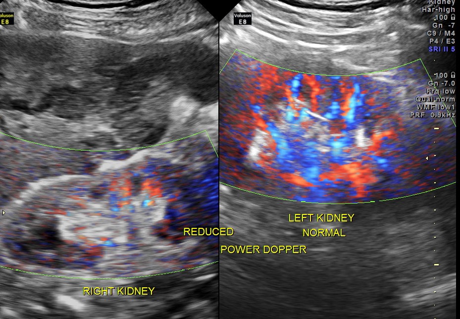 power doppler showed reduced flow in the right kidney