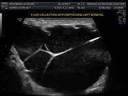 Hydrocele Ultrasound Ultrasound Case 068 LITFL POCUS