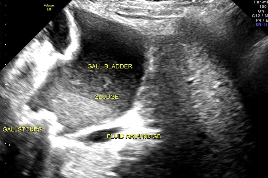 grossly distended gallbladder , with sludge and gallstones and fluid around the gall bladder.