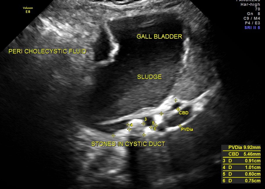 CYSTIC DUCT STONES ARE SEEN