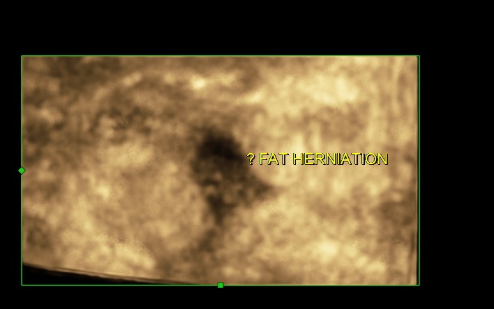 FAT HERNIATION_8