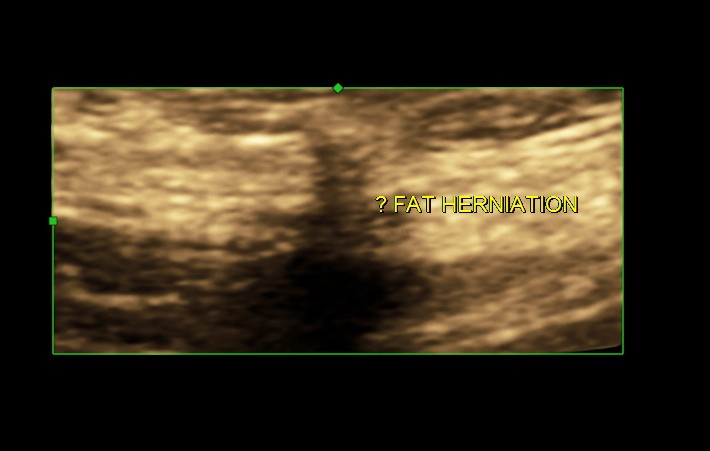 FAT HERNIATION_9