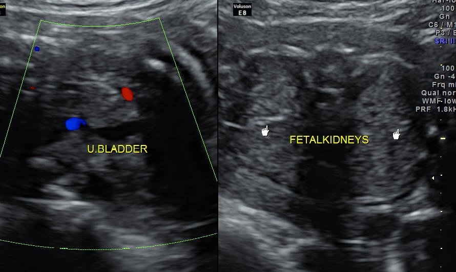 the kidneys as seen in the 26 week scan