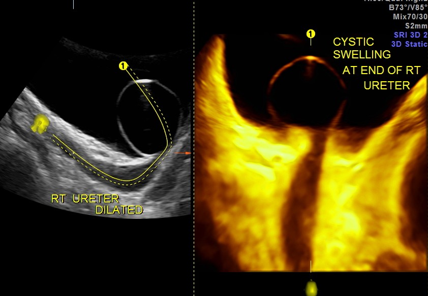 omni view shows the dilated ureter leading to the cystic swelling - Ureterocele