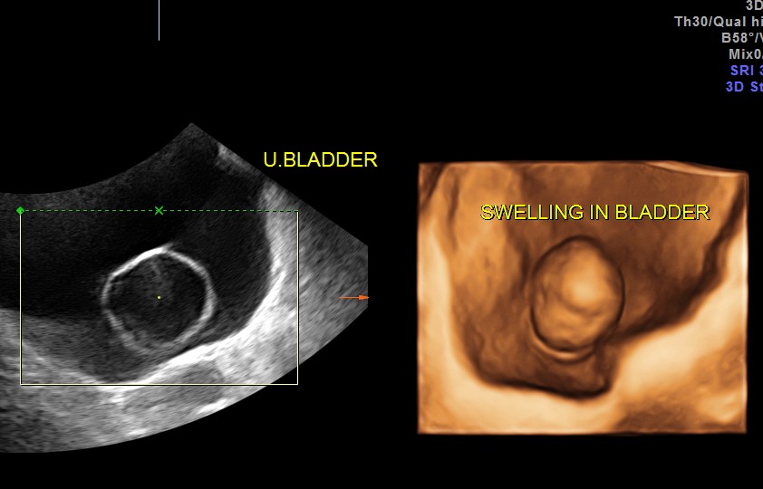 reconstructed image shows the swelling within the bladder