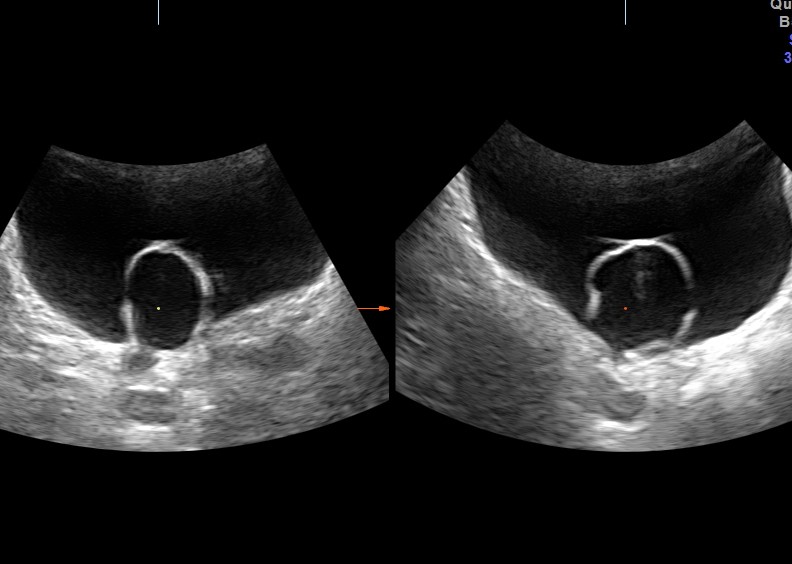 the picture on the left shows the dilated distal right ureter