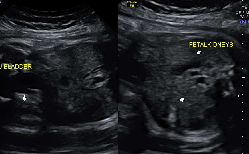 at 33 weeks of gestation