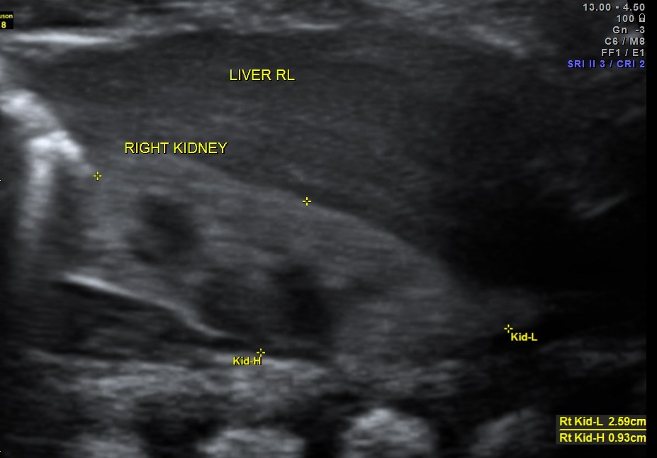 TOF RENAL DYSPLASIA CHILD_1