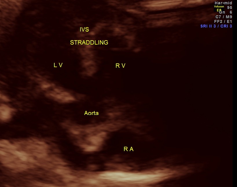 TOF RENAL DYSPLASIA CHILD_13