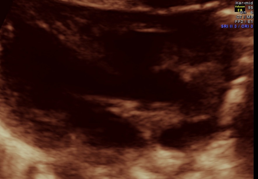 TOF RENAL DYSPLASIA CHILD_18