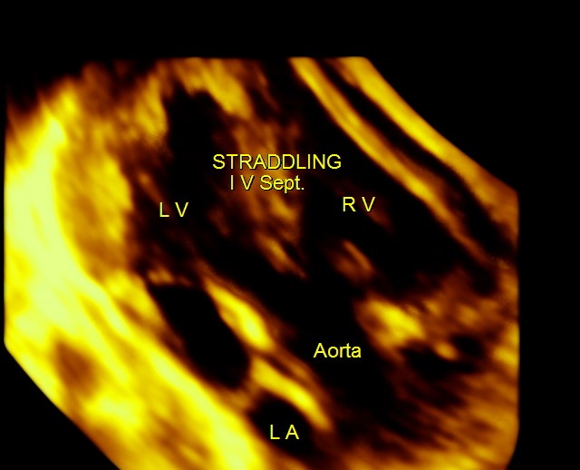 TOF RENAL DYSPLASIA CHILD_26