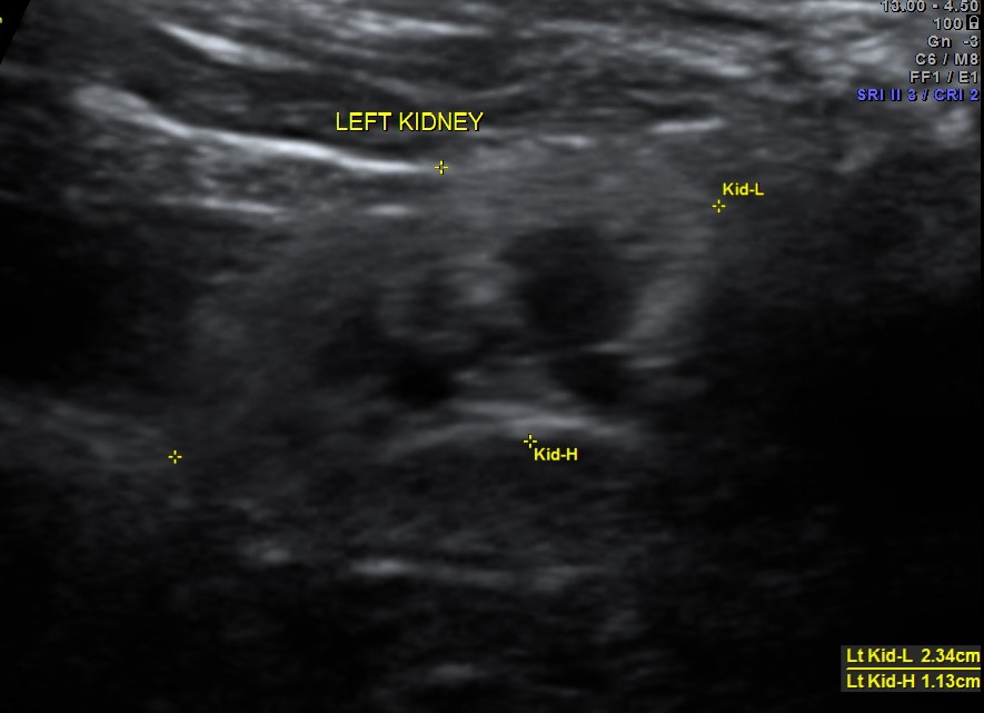TOF RENAL DYSPLASIA CHILD_3