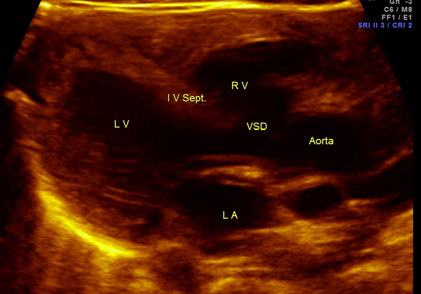 ivs straddling the aorta