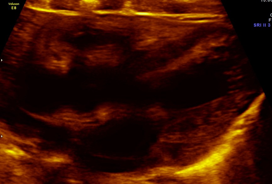 TOF RENAL DYSPLASIA CHILD_8