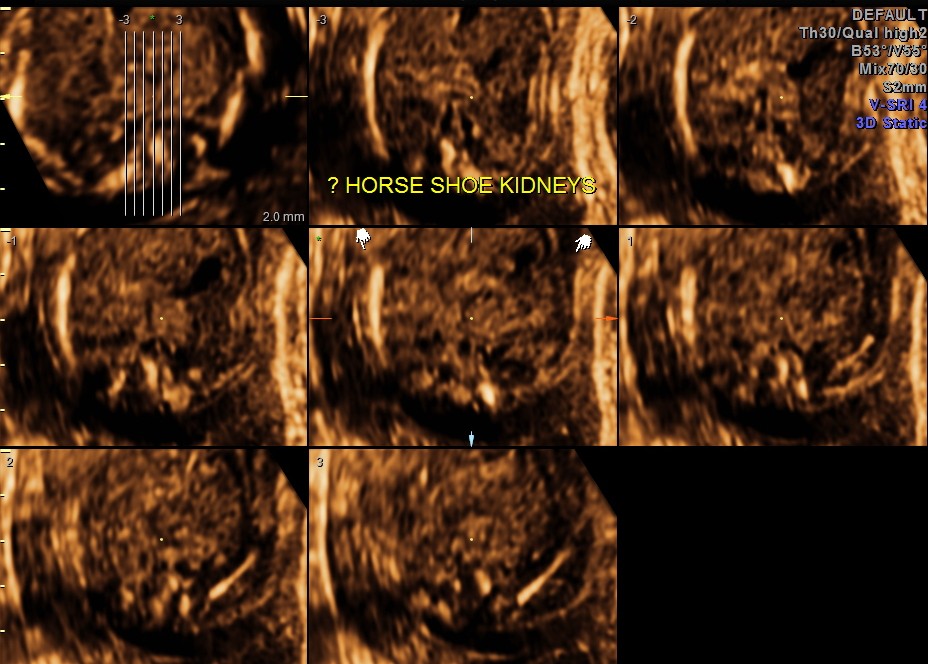 ANENCEPHALY HORSE SHOE KIDNEY_18