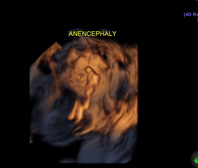 ANENCEPHALY HORSE SHOE KIDNEY_4