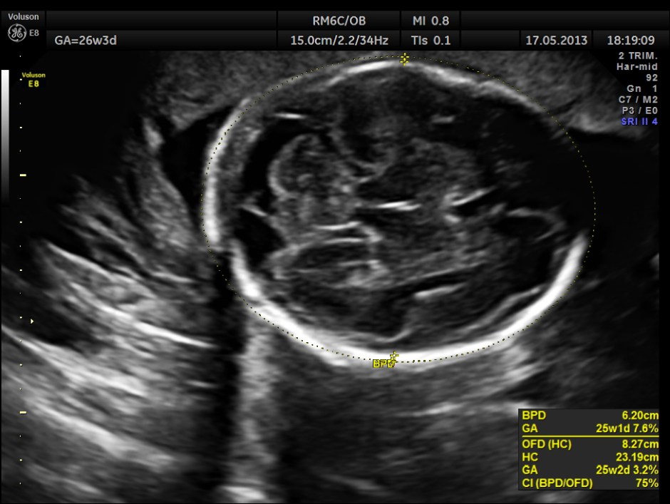 bpd corresponds to 25 w ga