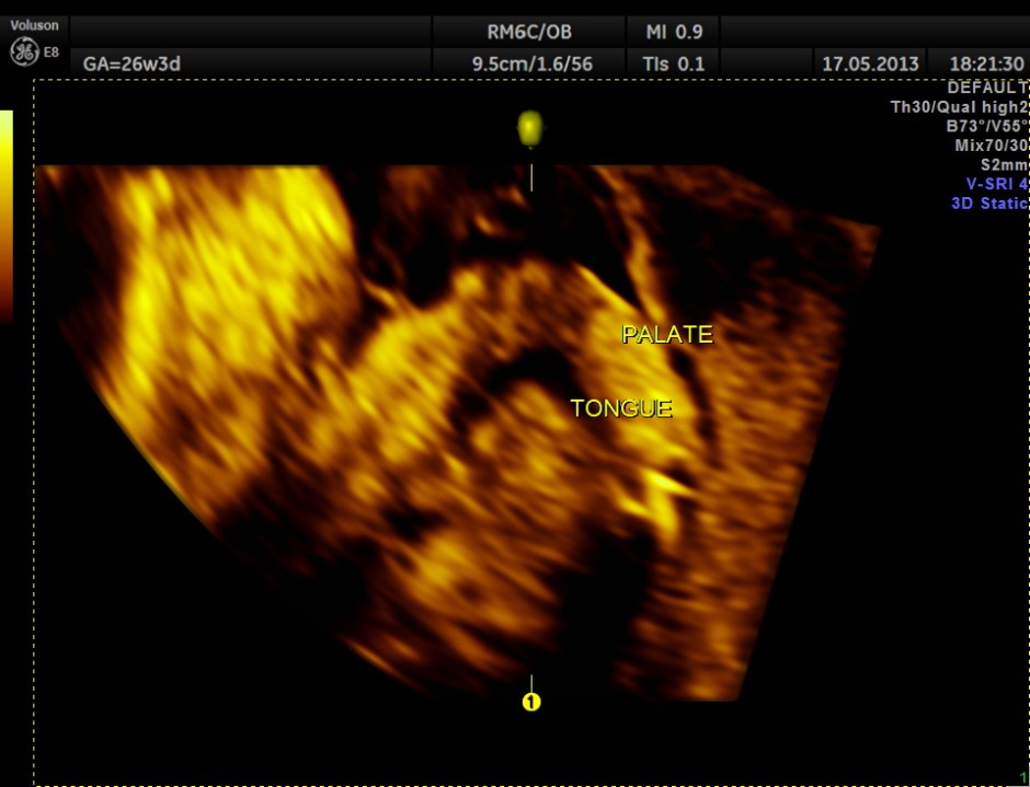 CARBAMAZEPINE CEREBELLAR HYPO_10