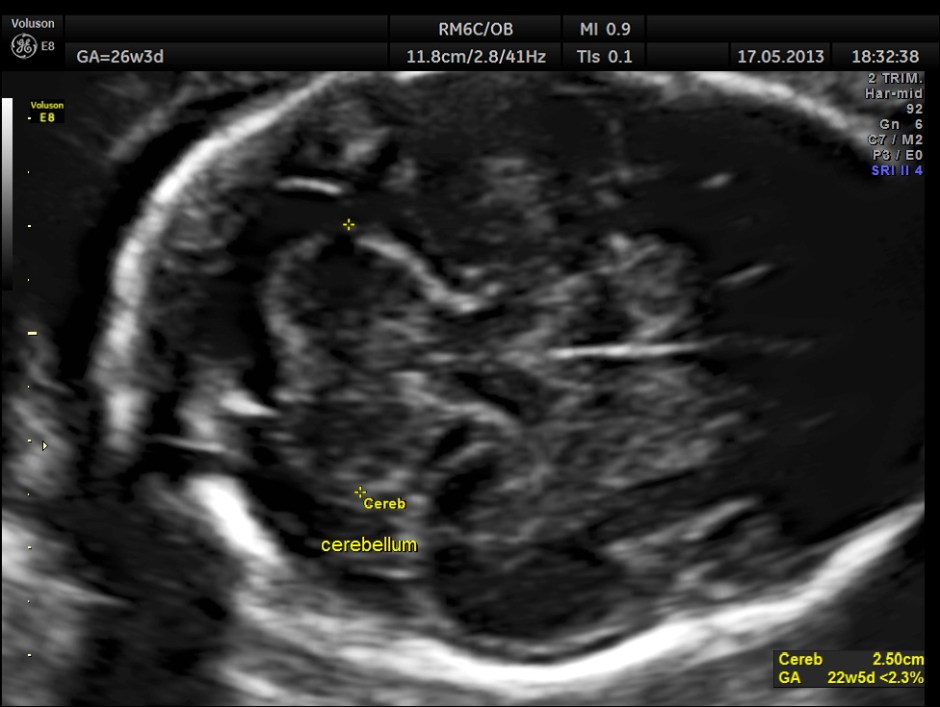 CARBAMAZEPINE CEREBELLAR HYPO_11