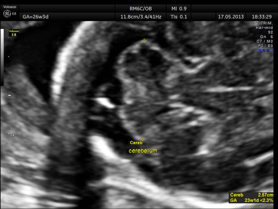 CARBAMAZEPINE CEREBELLAR HYPO_12