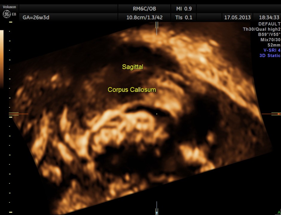CARBAMAZEPINE CEREBELLAR HYPO_13