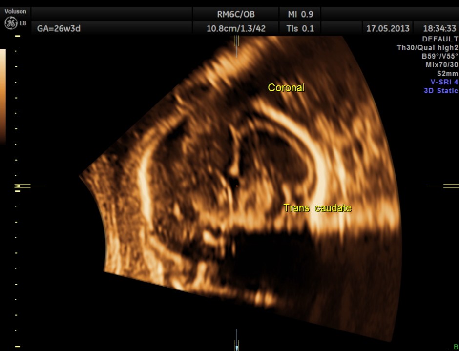 CARBAMAZEPINE CEREBELLAR HYPO_14