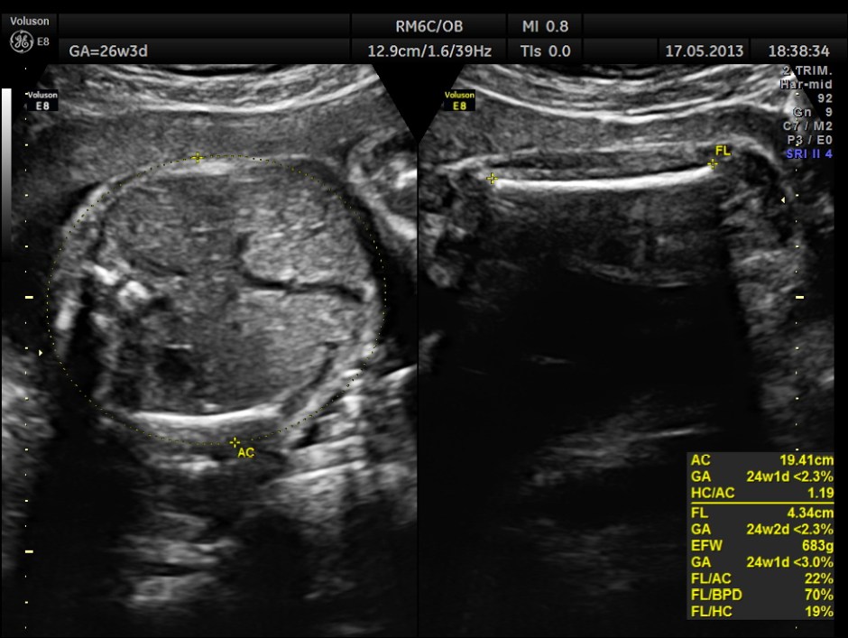 CARBAMAZEPINE CEREBELLAR HYPO_17