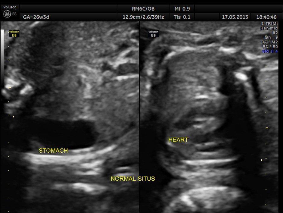 CARBAMAZEPINE CEREBELLAR HYPO_18