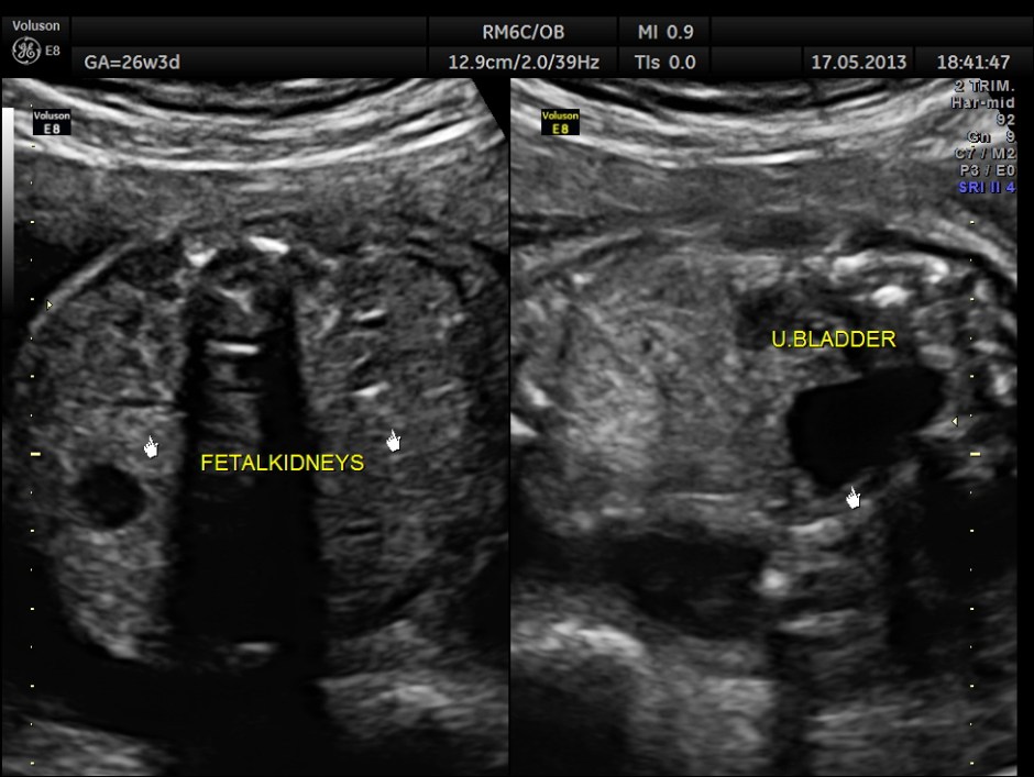CARBAMAZEPINE CEREBELLAR HYPO_19