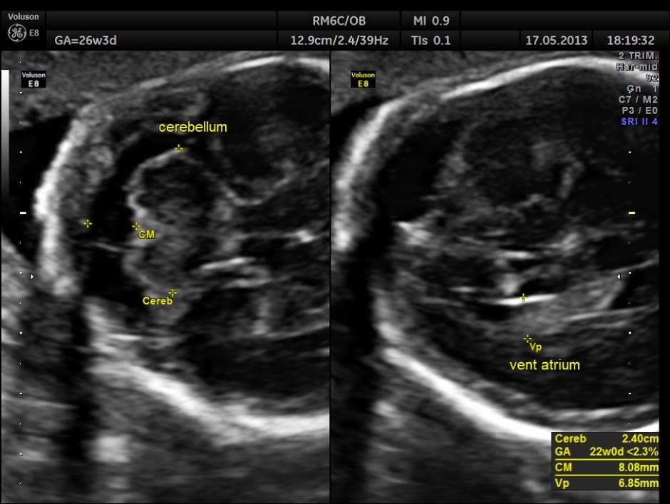 CARBAMAZEPINE CEREBELLAR HYPO_2