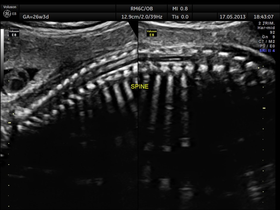 CARBAMAZEPINE CEREBELLAR HYPO_20