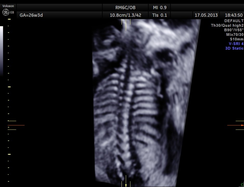 CARBAMAZEPINE CEREBELLAR HYPO_21