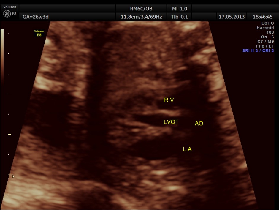 CARBAMAZEPINE CEREBELLAR HYPO_22