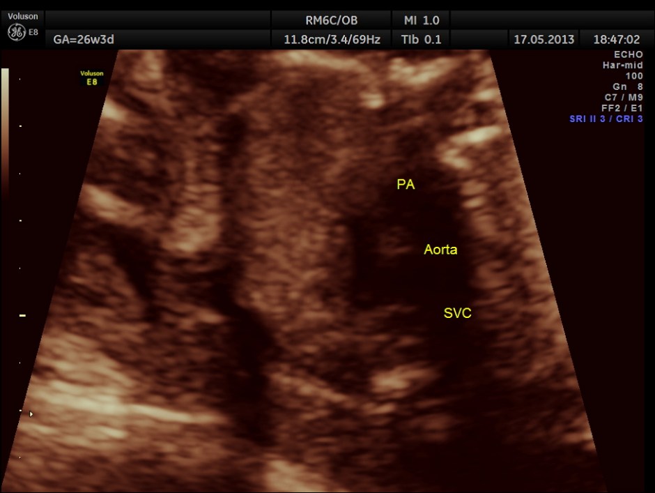 CARBAMAZEPINE CEREBELLAR HYPO_23