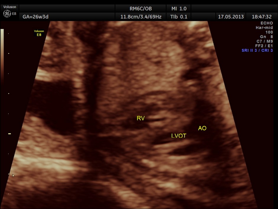 CARBAMAZEPINE CEREBELLAR HYPO_24