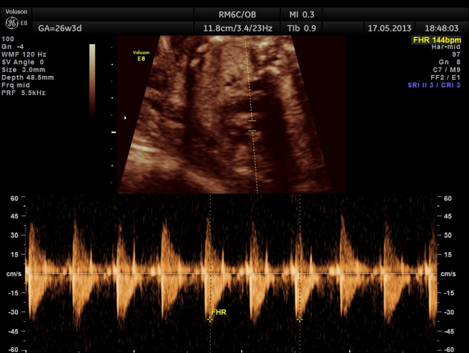CARBAMAZEPINE CEREBELLAR HYPO_25